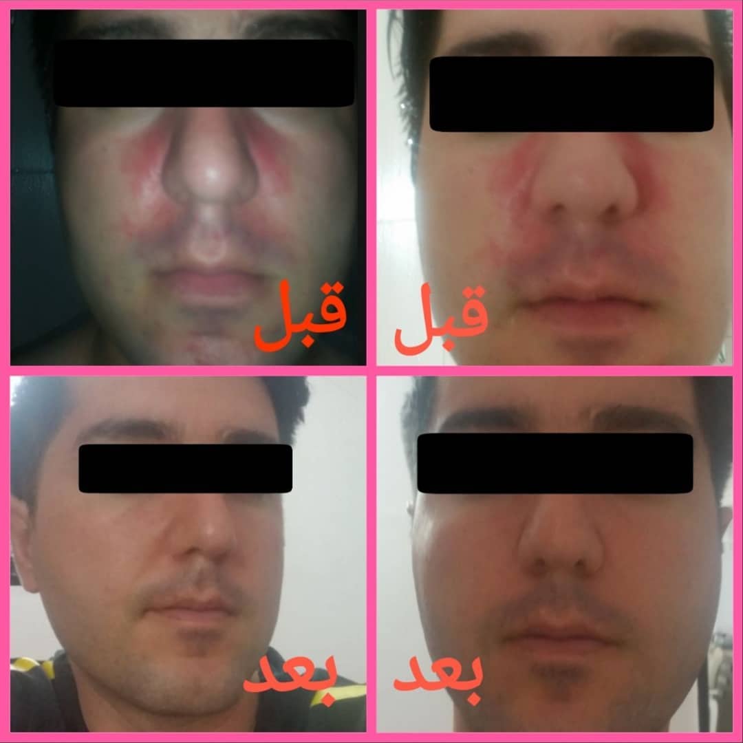 نمونه درمان روزاسه