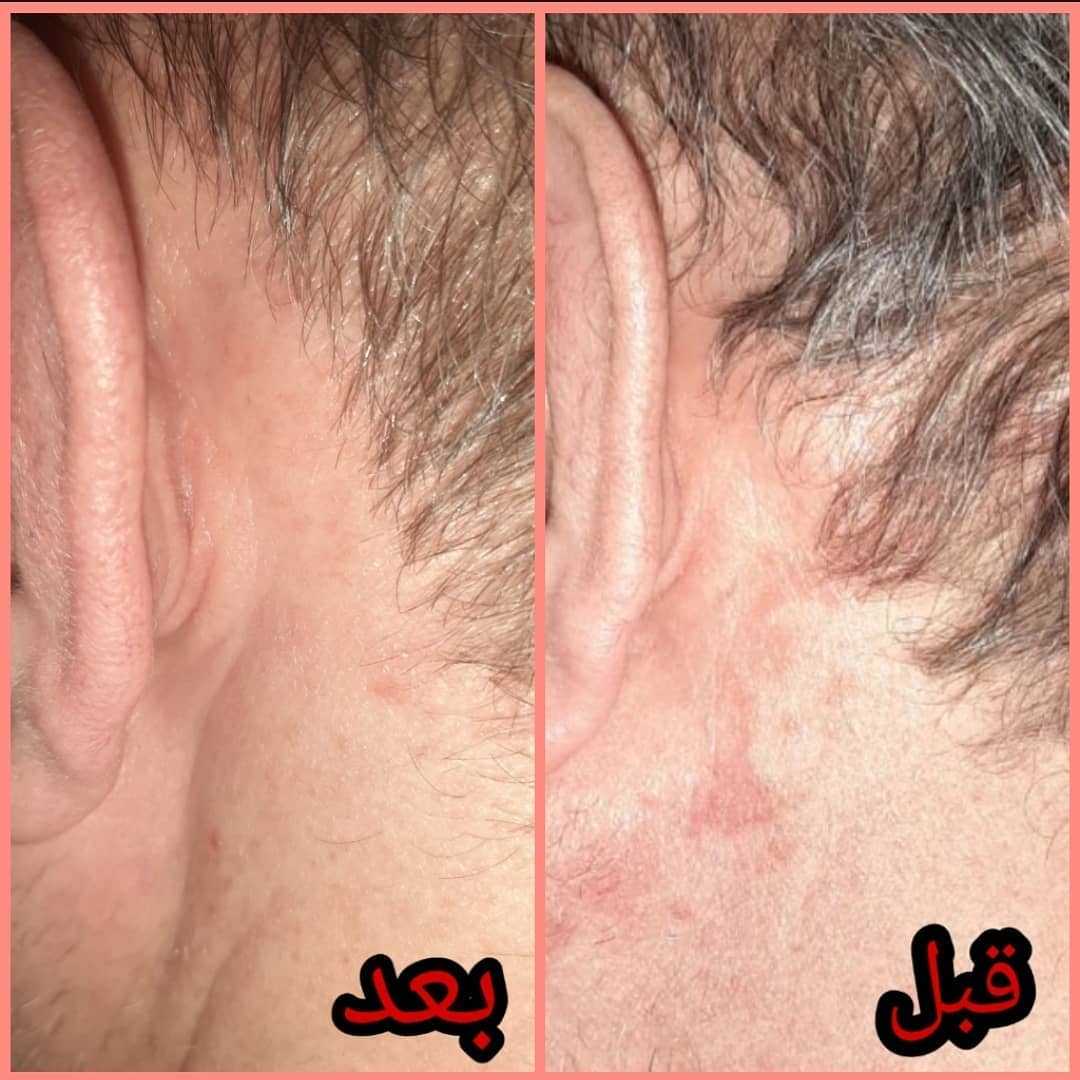 نمونه درمان روزاسه