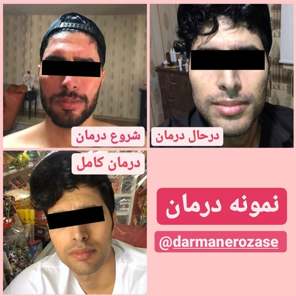 نمونه درمان روزاسه