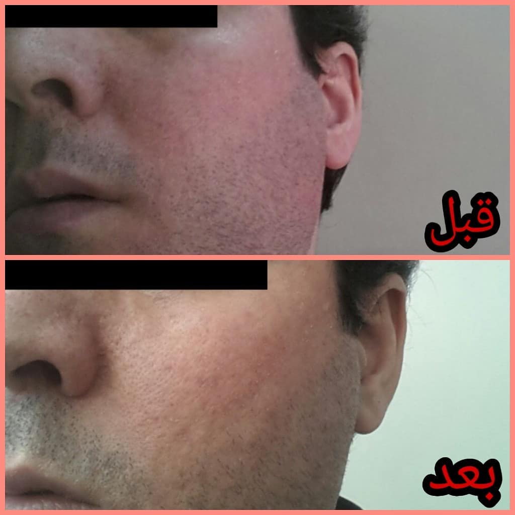 نمونه درمان روزاسه