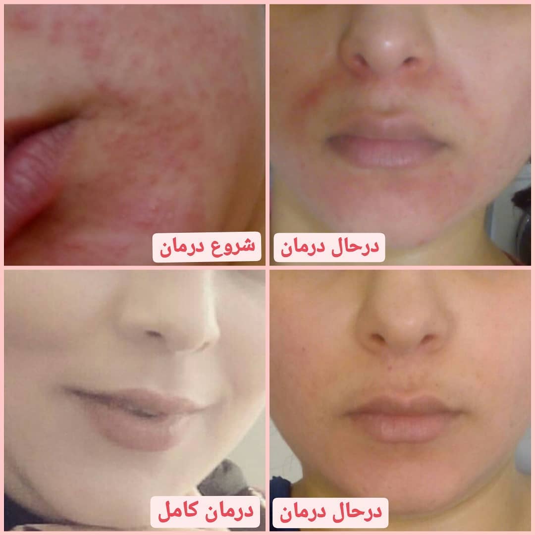 نمونه درمان روزاسه و درماتیت