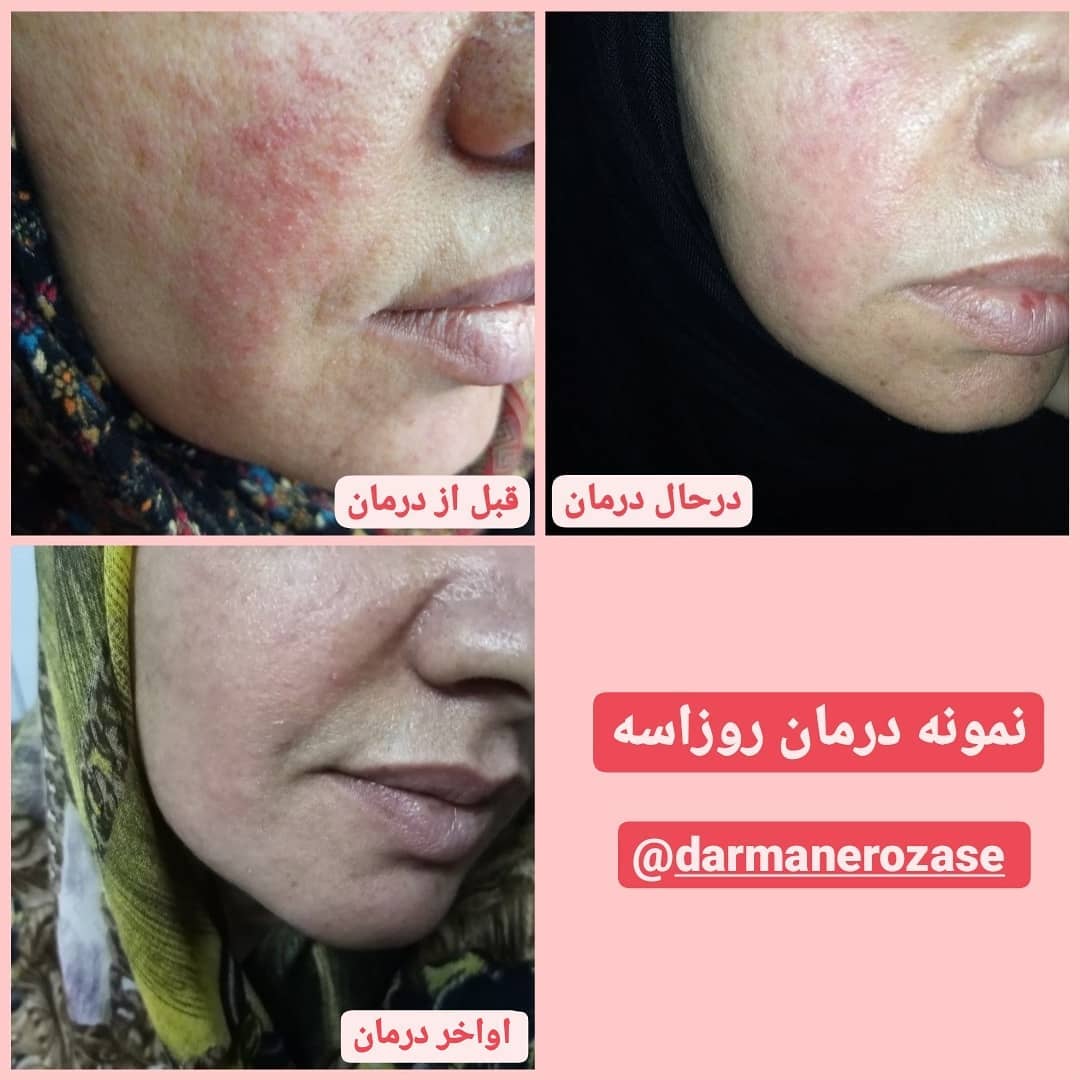 نمونه درمان روزاسه و جوش صورت