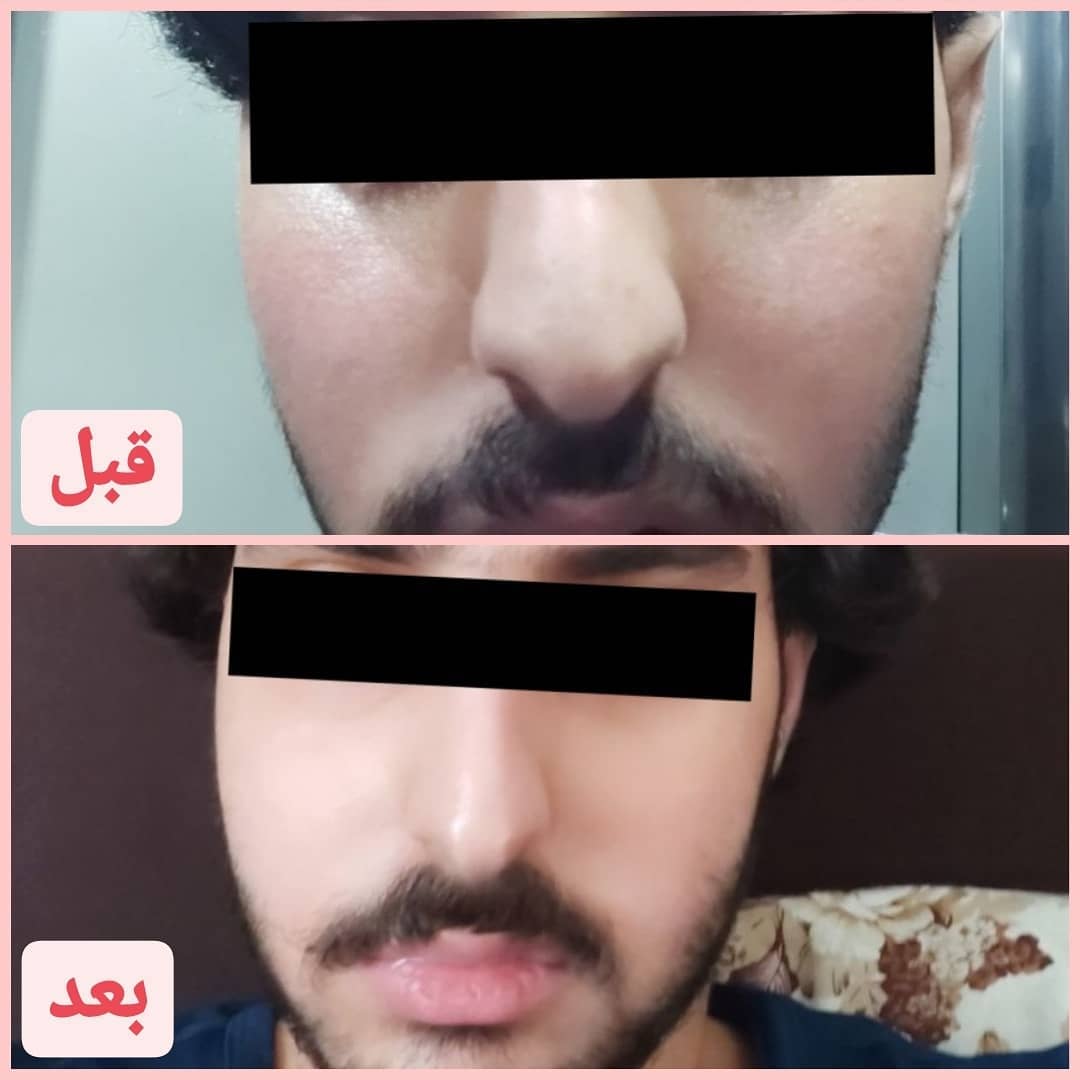 نمونه درمان روزاسه