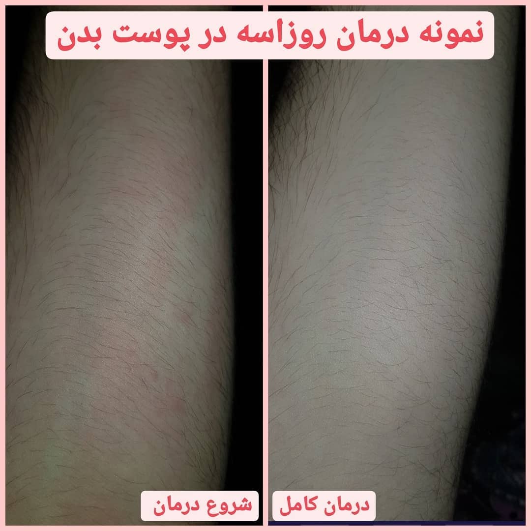 نمونه درمان روزاسه