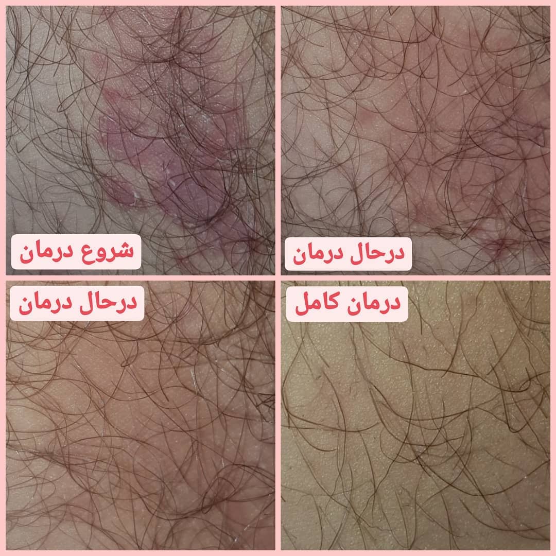 نمونه درمان درماتیت در پوست بدن
