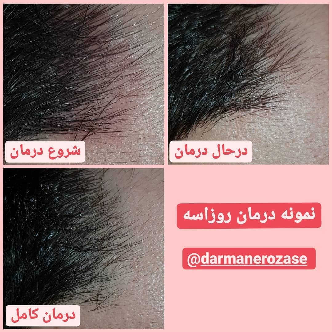 نمونه درمان روزاسه در پوست سر