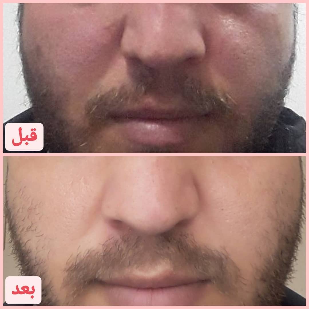 نمونه درمان روزاسه