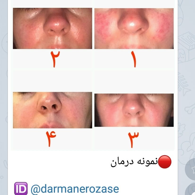 نمونه درمان روزاسه