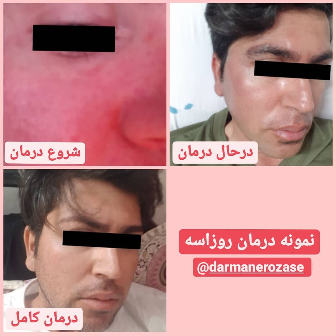 نمونه درمان روزاسه
