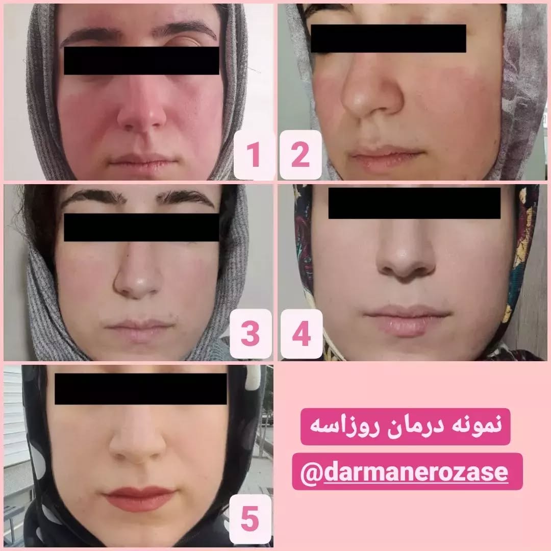 نمونه درمان روزاسه