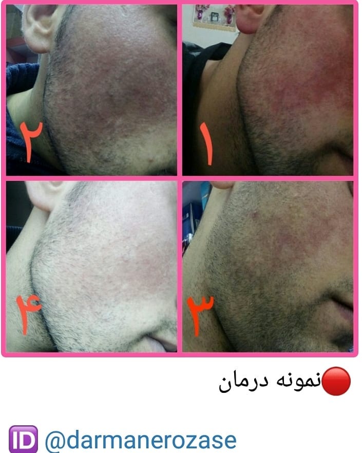 نمونه درمان روزاسه