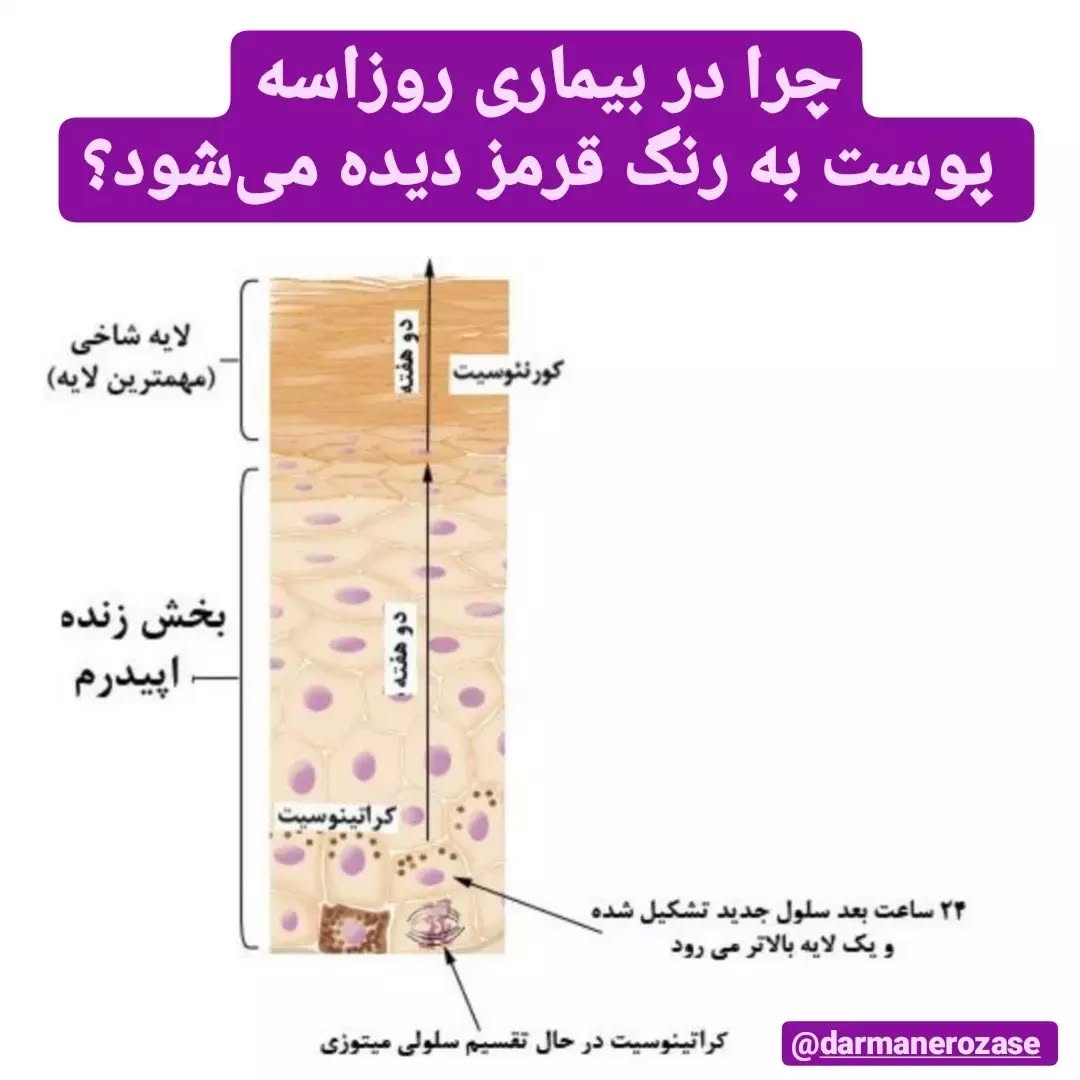 چرا در بیماری روزاسه، پوست به رنگ قرمز دیده می‌شود؟