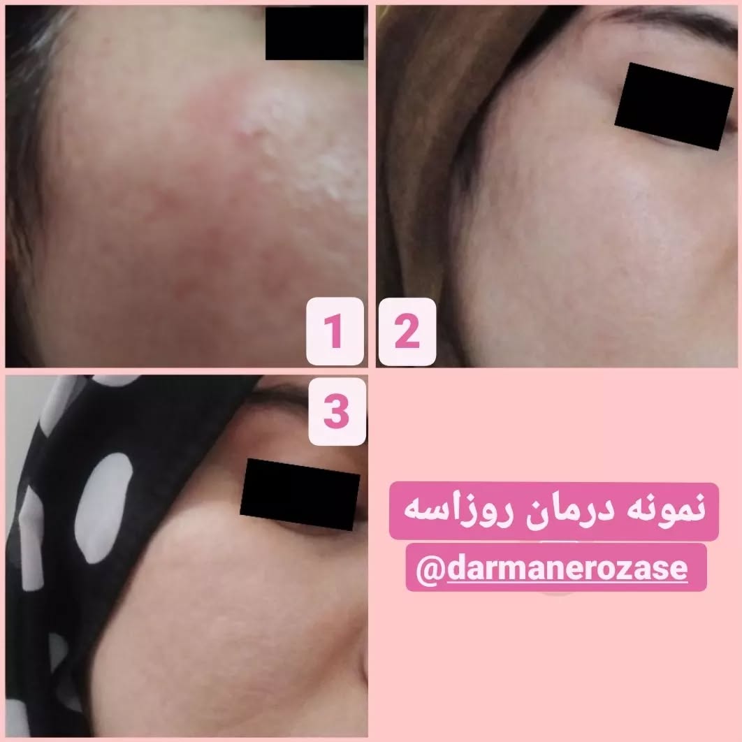 نمونه درمان روزاسه