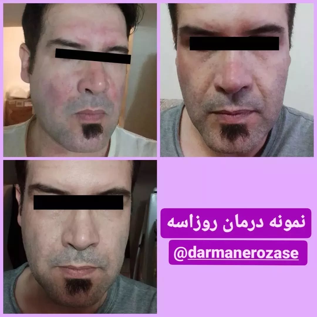 نمونه درمان روزاسه