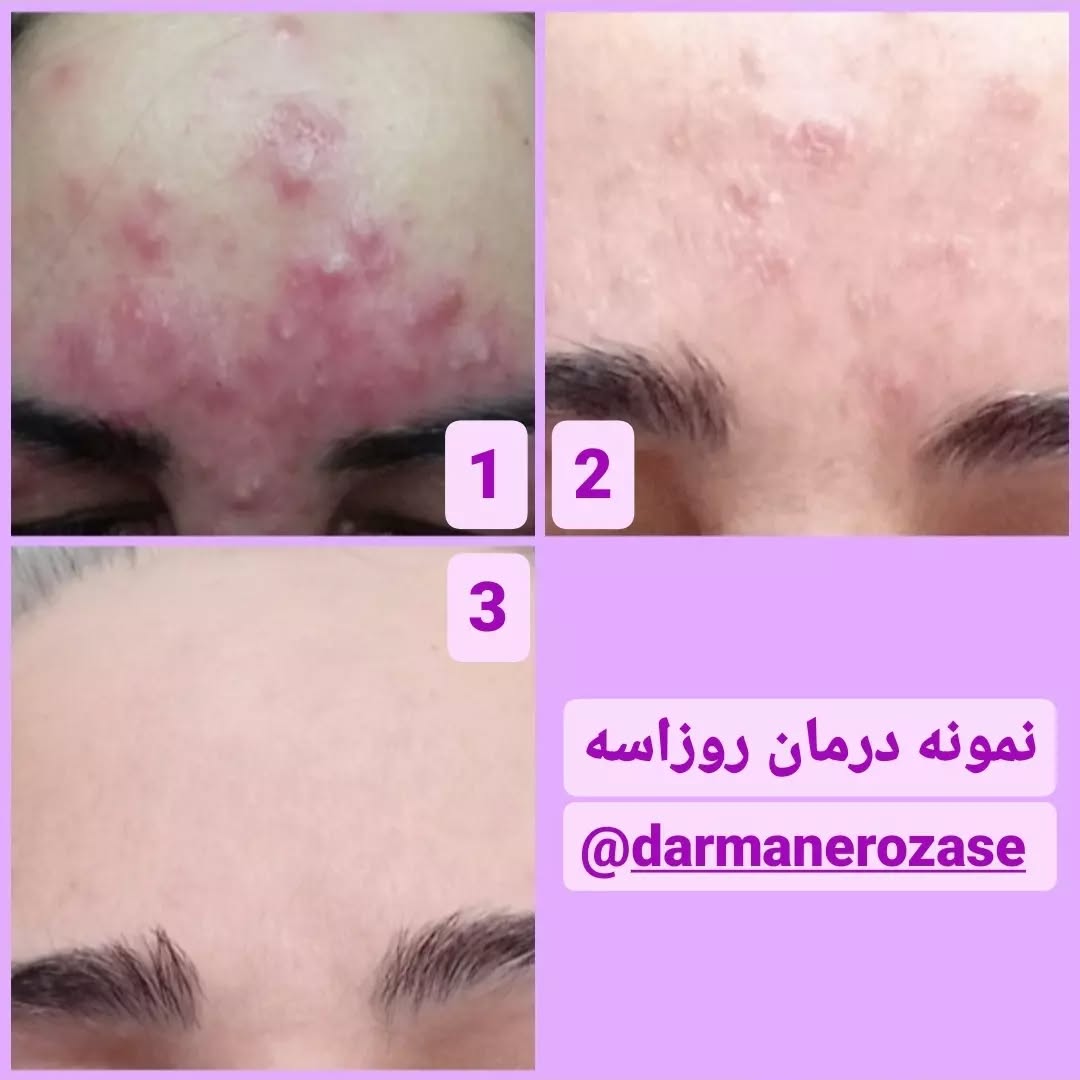 نمونه درمان روزاسه