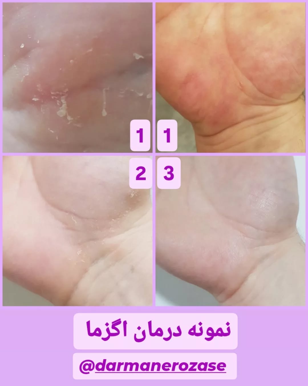نمونه درمان اگزما