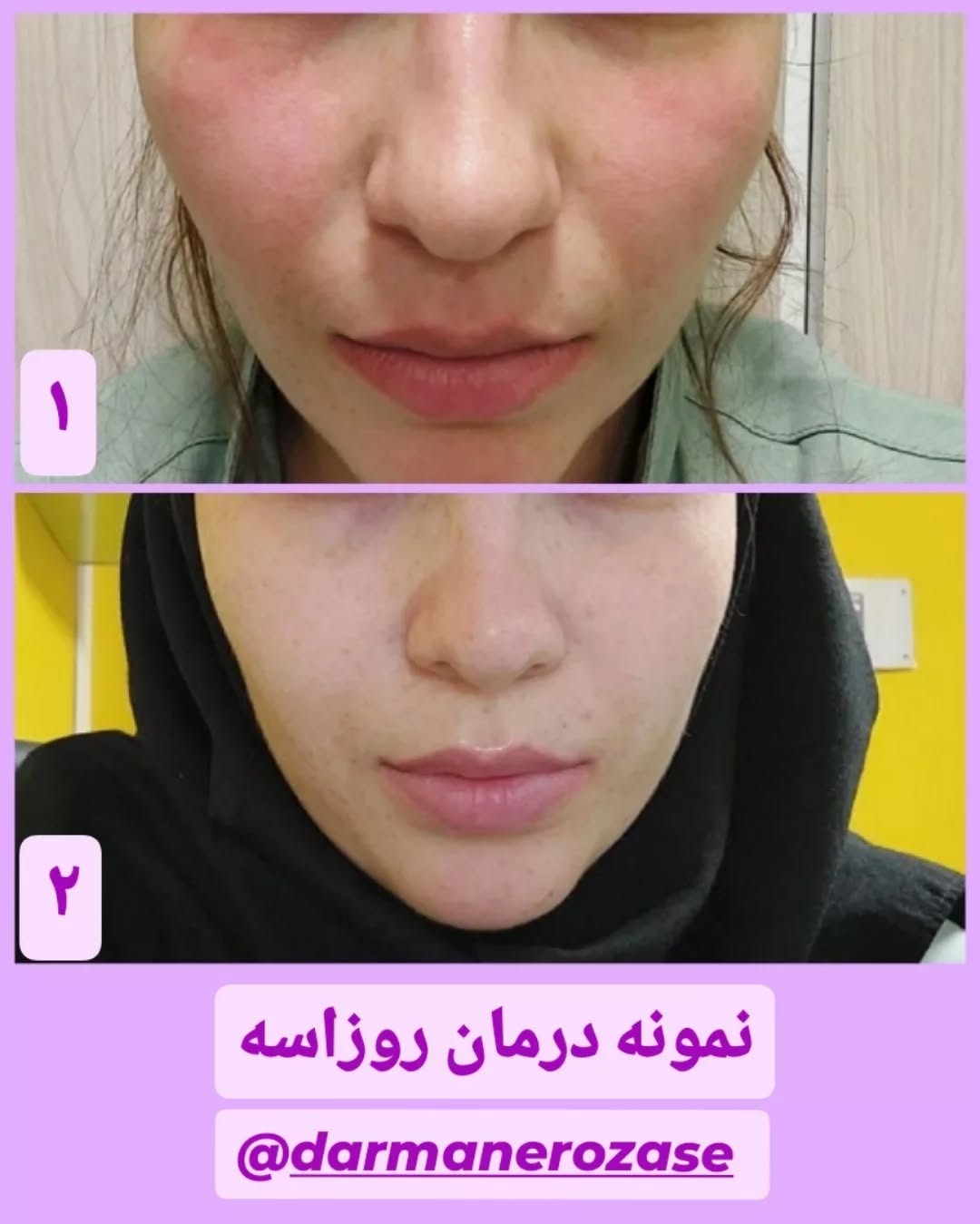 نمونه درمان روزاسه