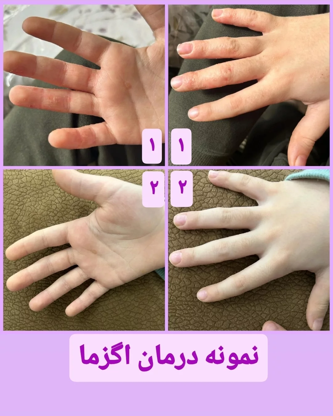 نمونه درمان اگزما