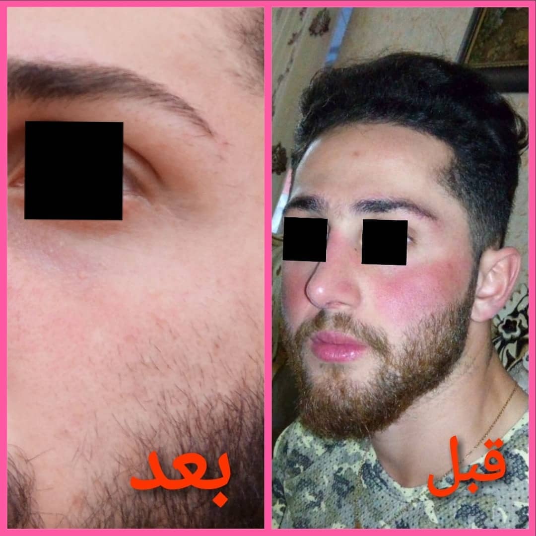 نمونه درمان روزاسه