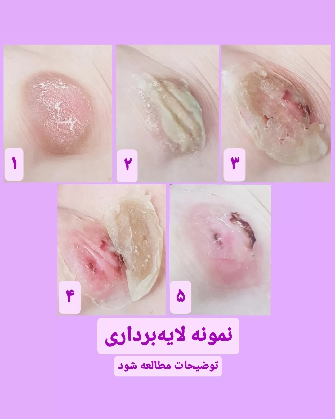 در چه شرایطی از لایه بردار استفاده کنیم؟