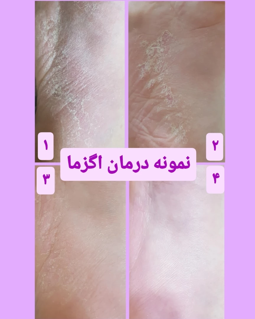 نمونه درمان اگزما